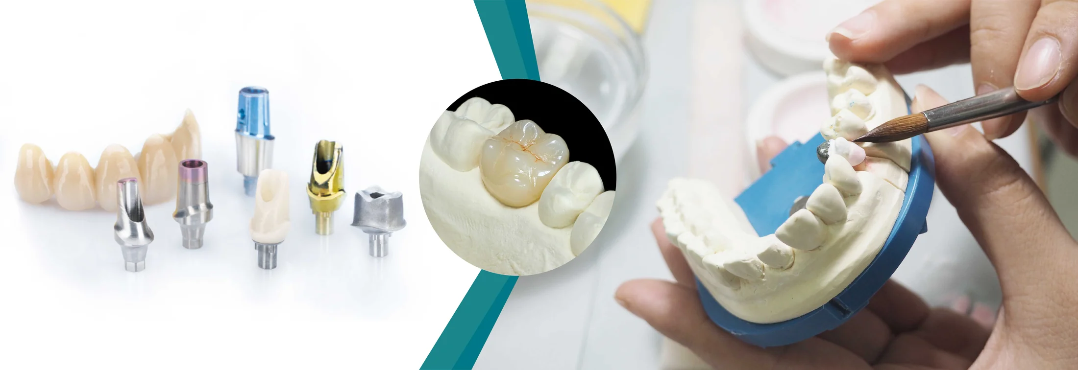 Dental restoration craftsmanship and components